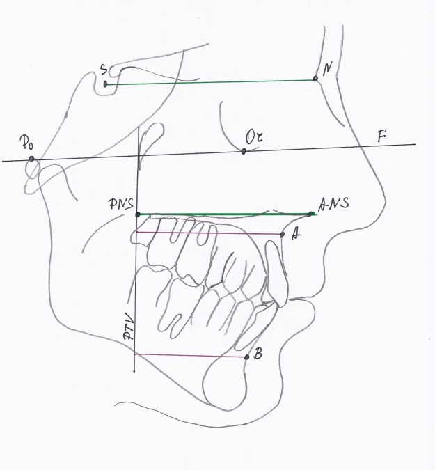 Analysis of the sagittal dentoalveolar and skeletal changes