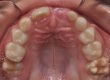Arrested-eruption-of-first-permanent-molar