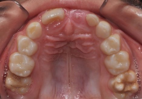 Arrested-eruption-of-first-permanent-molar
