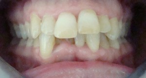 Frequency And Characteristics Of Malocclusion In Adult Patients