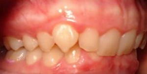 Interdisciplinary Treatment of Patients with Deep Overbite and Parafunctional Activity