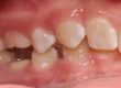 Problems in the treatment of ankylosing deciduous molars