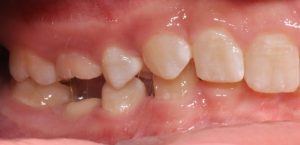 Problems in the treatment of ankylosing deciduous molars