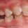 Problems in the treatment of ankylosing deciduous molars