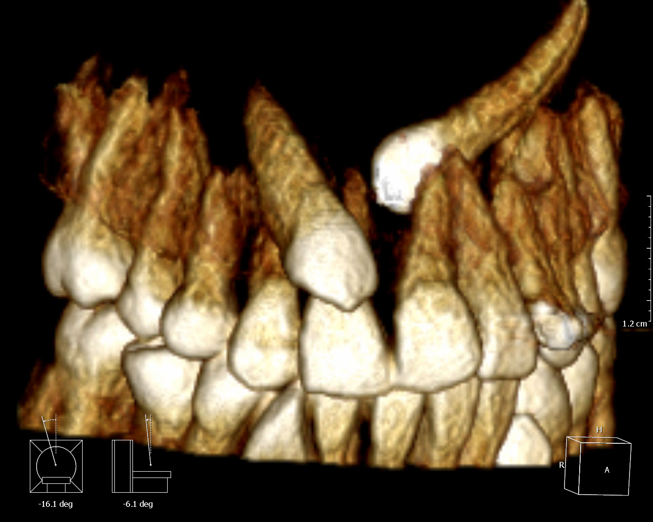 Rate And Characteristics Of Dental Transposition — Oртодонтска клиника ...