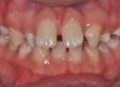 TOOTH AGENESIS