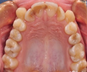 Апарати за постигане на място в горната зъбна дъга