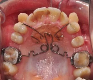 Апарати за постигане на място в горната зъбна дъга