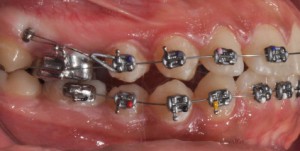 Ортодонтски микро импланти