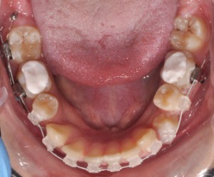 Ортодонтски микро импланти