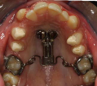 distalizirane-na-gorni-molari-s-aparatite-pendulum-i-frog