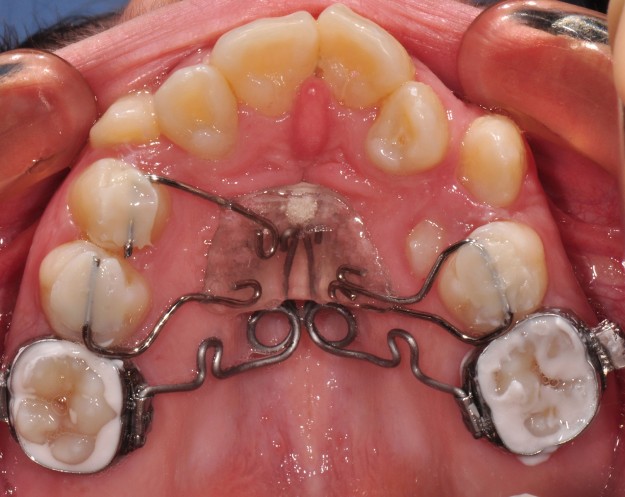 klinichni-aspekti-pri-prilagane-na-aparata-pendulum-v-smeseno-suzubie