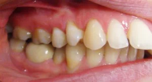 Комплексни ортодонтски лечения