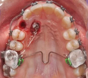 Комплексни ортодонтски лечения