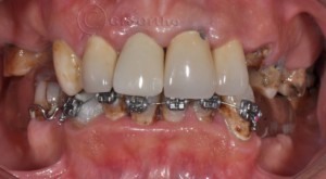 Комплексно ортодонтско-протетично лечение