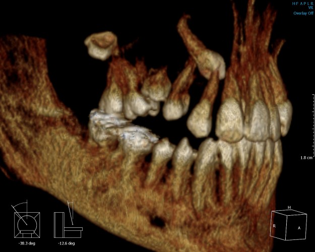 kompliciran-sluchai-na-retiniran-goren-kanin