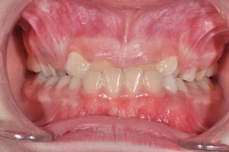 krustosana-zahapka-vuv-frontalnia-segment