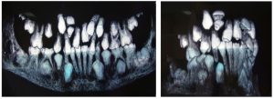 Лечение на свръхбройни заби и ретенирани зъби