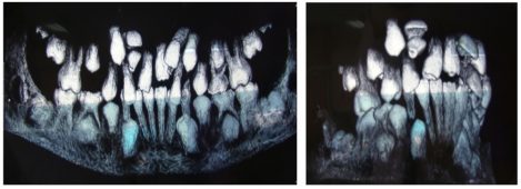 lechenie-na-svruhbroini-zubi-i-retenirani-zubi