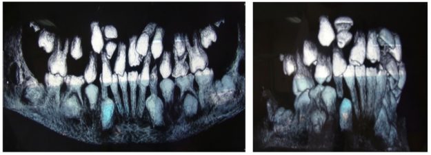 lechenie-na-svruhbroini-zubi-i-retenirani-zubi
