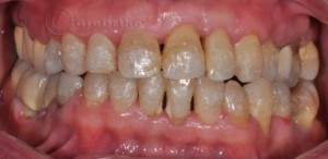 Лечение при пародонтално мигрирали зъби