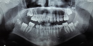 Ортодонтско лечение при множествена хиподонтия