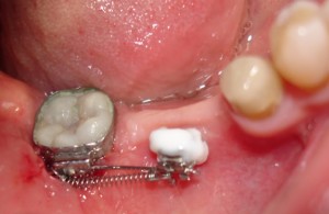 Превръщане на дистално неограничен дефект в ограничен чрез ортодонтско преместване на полуретиниран долен трети молар