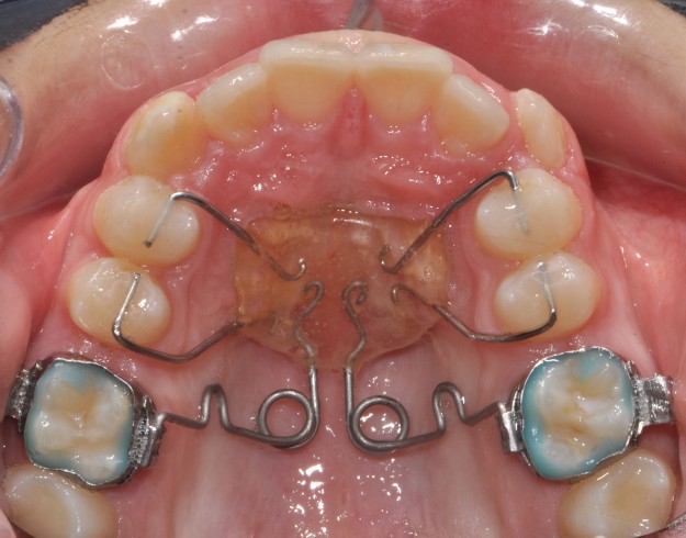 predimstva-na-metodite-na-lechenie-s-intraoralnia-fiksiran-aparat-m-pendulum