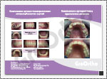 Комплексно ортодонтско-протетично лечение