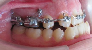 Ролята на мини имплантите при усложнени ортодонтски лечения