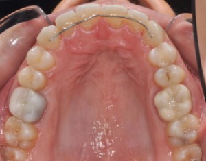 Възрастова ортодонтия